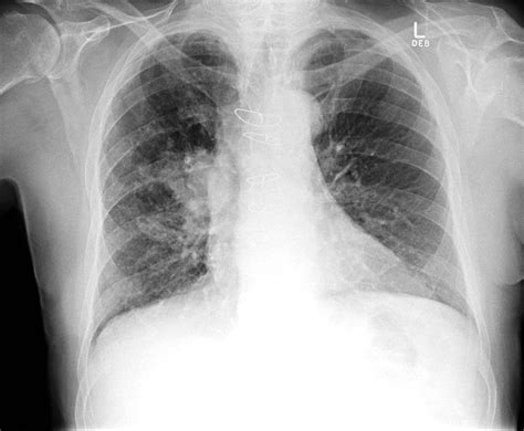 The Pulmonary Hilus and Lung Cancer